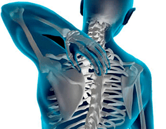 Manifestationen der Osteochondose der Brustwirbelsäule