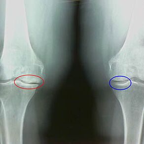 Arthrose des Kniegelenks auf der Radiographie